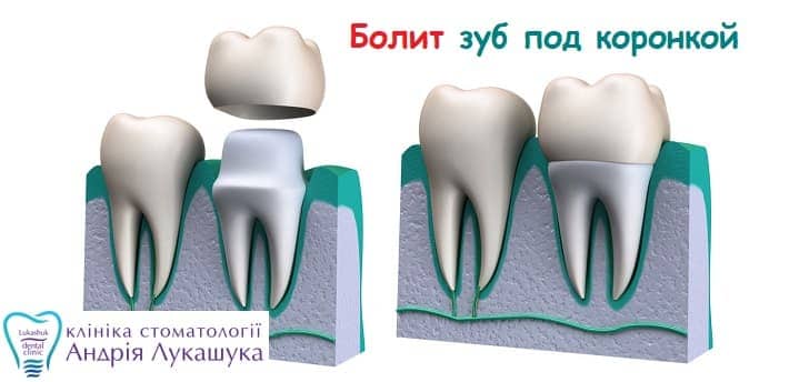 Болит зуб под коронкой - Клиника Лукашука