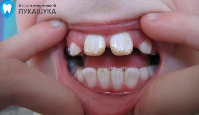 Флюороз: поражение зубов из за избытка фтора в воде | Фото 4 - Клиника Лукашука