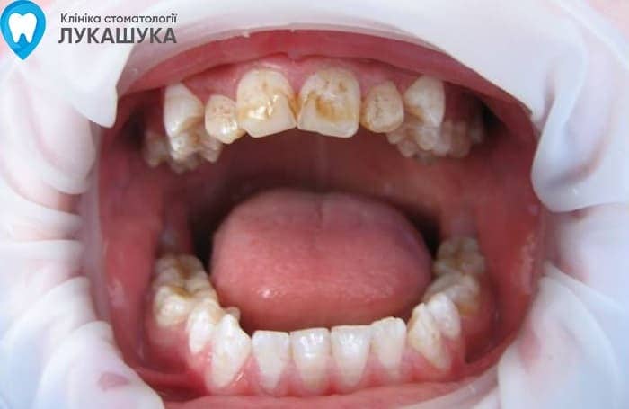 Флюороз: поражение зубов из за избытка фтора в воде | Фото 5 - Клиника Лукашука