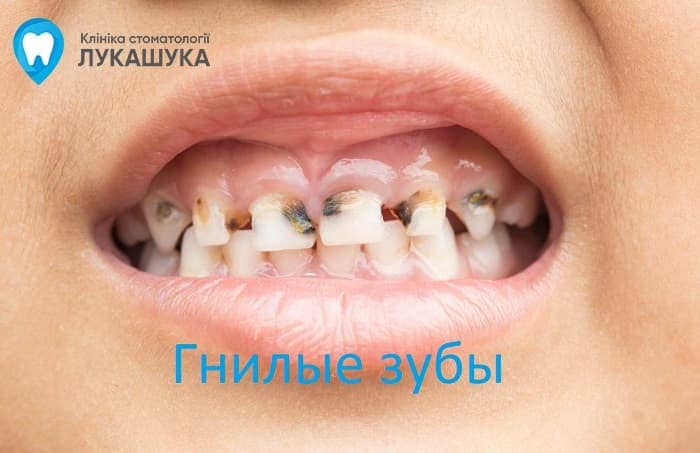 Гнилые зубы | Фото 1 - Клиника Лукашука