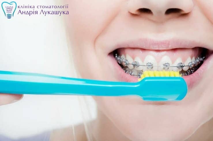 Как чистить зубы с брекетами | Фото 3 - Клиника Лукашука