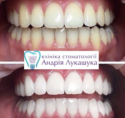 Отбеливание зубов | Фото работы - Клиника Лукашука