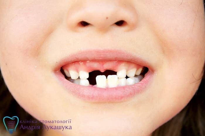 Во сколько лет выпадают молочные зубы | Фото 2 - Клиника Лукашука