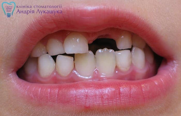 Во сколько лет выпадают молочные зубы | Фото 5 - Клиника Лукашука