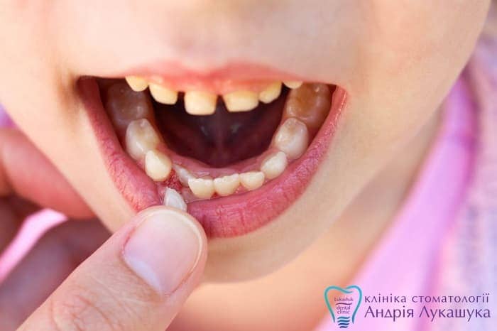 Во сколько лет выпадают молочные зубы | Фото 3 - Клиника Лукашука