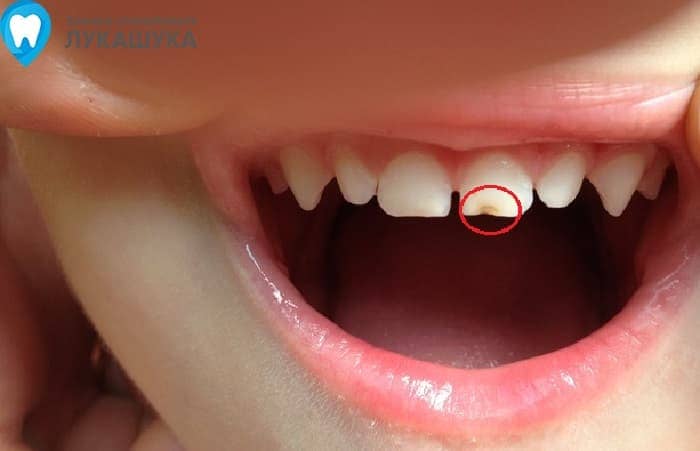Откололся зуб | Фото 3 - Клиника Лукашука