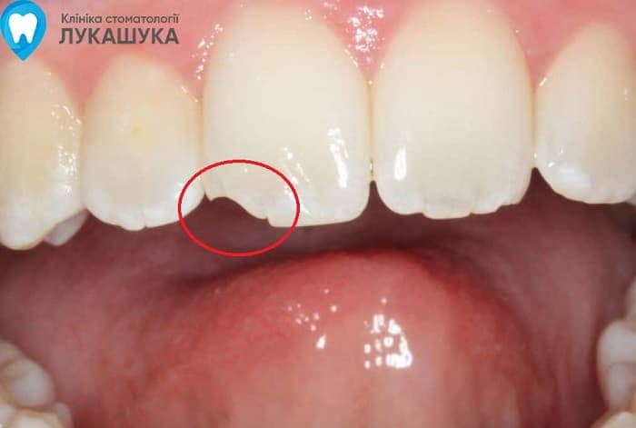 Откололся зуб | Фото 5 - Клиника Лукашука