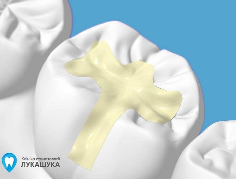 Пломба в стоматологии | Фото 1 - Клиника Лукашука