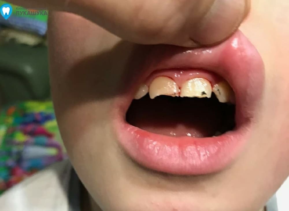 Ребенок выбил зуб | Фото 2 - Клиника Лукашука