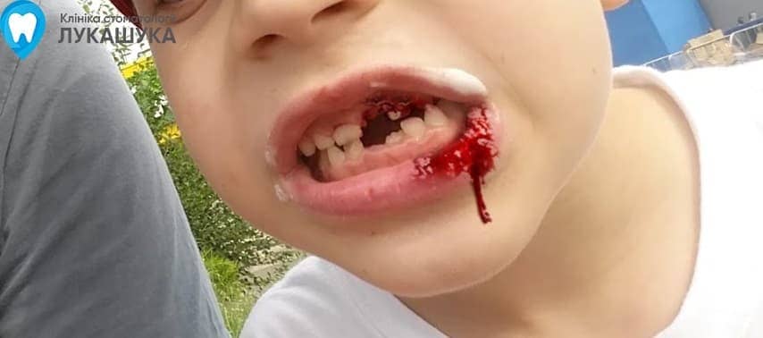 Ребенок выбил зуб | Фото 1 - Клиника Лукашука