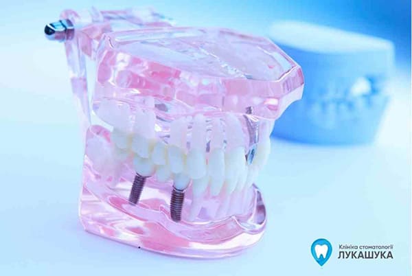 Модель для наглядности зубного протезирования