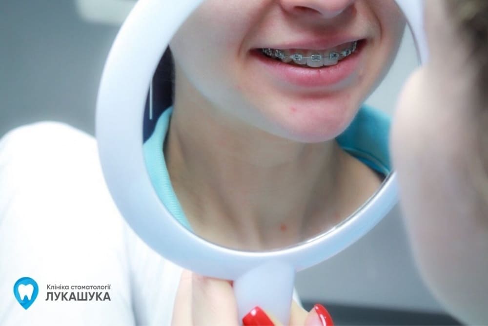 Зубная паста для брекетов | Фото 3 - Клиника Лукашука