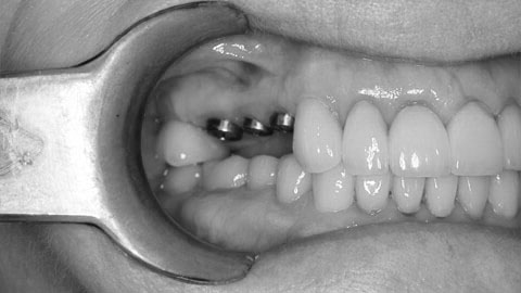 Классификация и виды отторжения зубного импланта