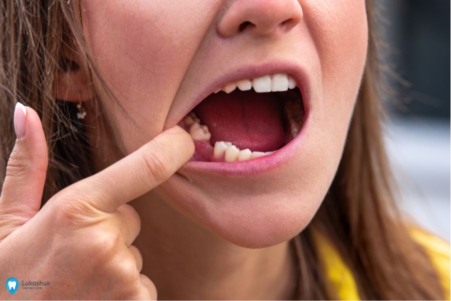 Видалення зуба ультразвуком | Фото 3 - Клініка Лукашука