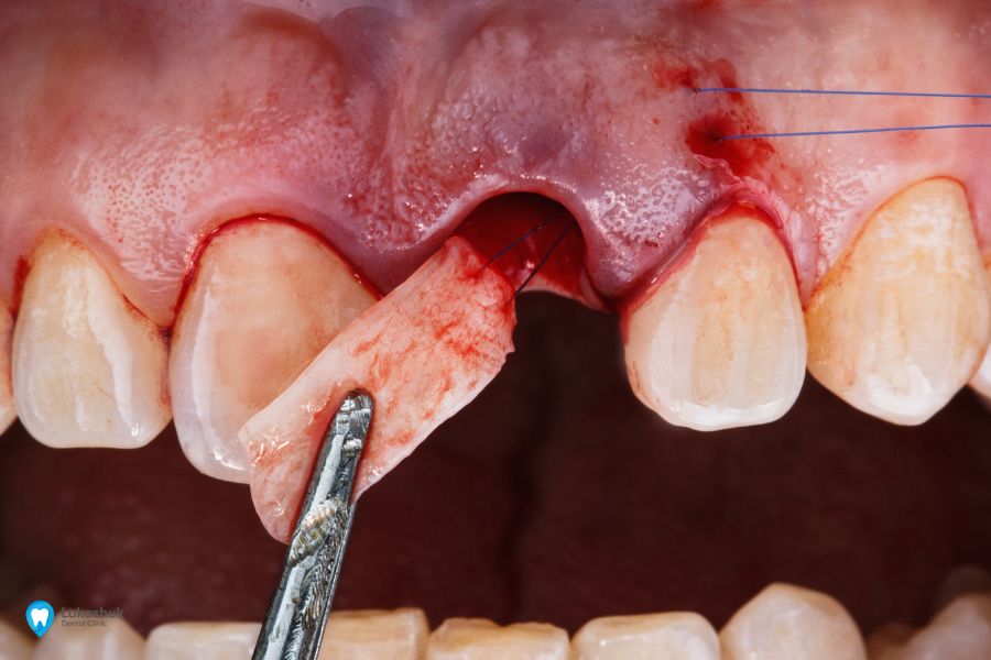Видалення зуба ультразвуком | Фото 5 - Клініка Лукашука