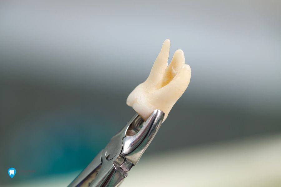 Видалення зуба ультразвуком | Фото 2 - Клініка Лукашука