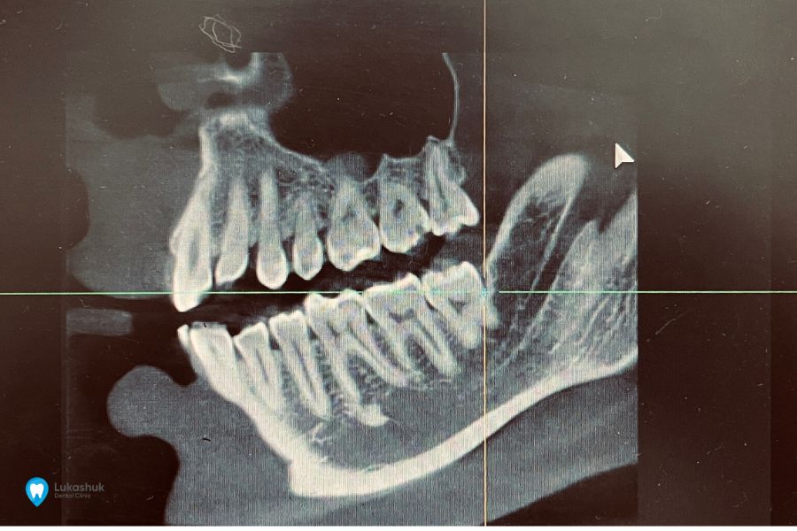 Протезування зубів на імплантах фото 9