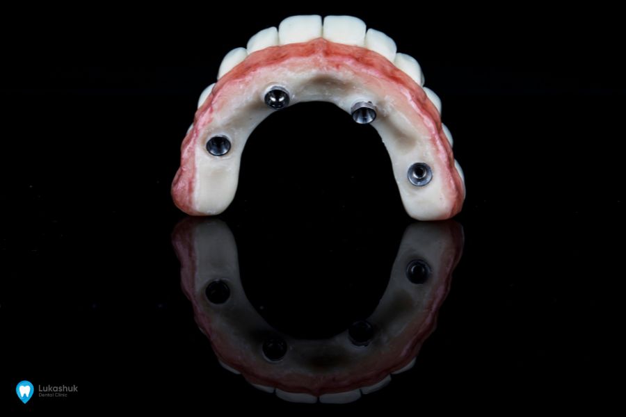 Протезування зубів на імплантах фото 5
