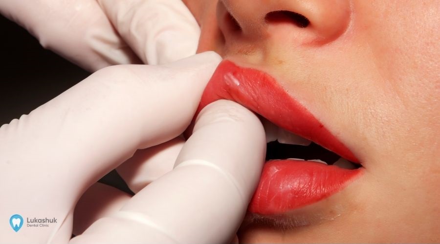 Пластика уздечки губы в клинике Лукашука | Фото 1