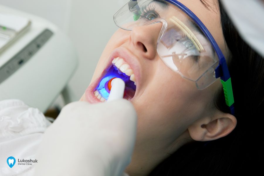 Як проходить пломбування зубів