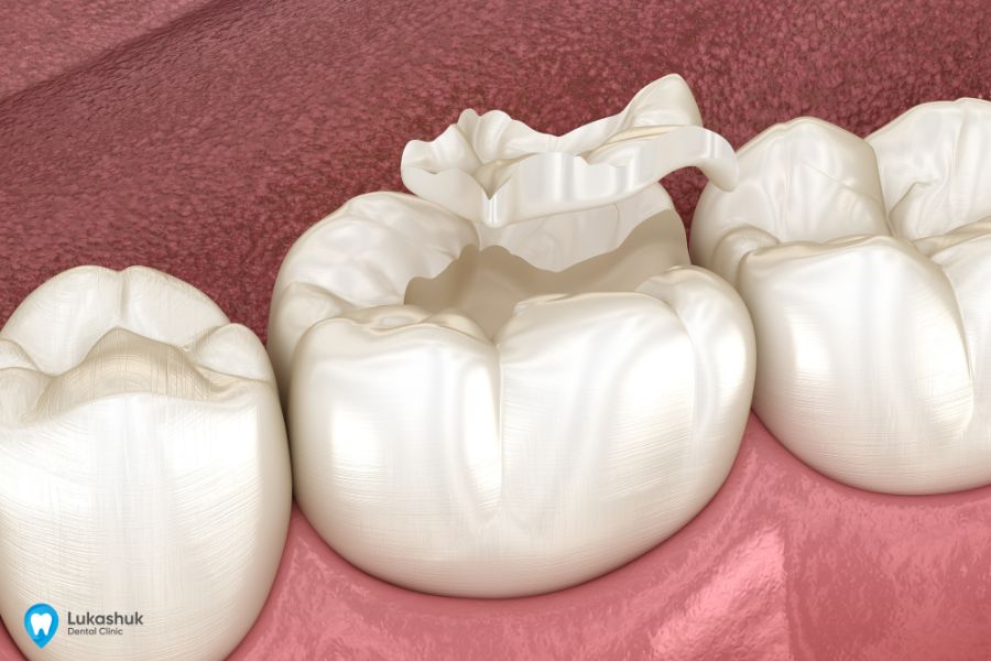 Восстановление коронки зуба в клинике Лукашука