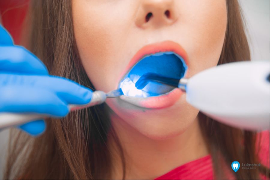 Сучасні методи пломбування зубів в клініці Лукашука