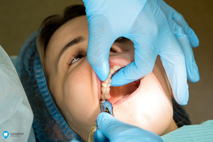 Завершающий этап удаления зуба мудрости | Клиника лукашука