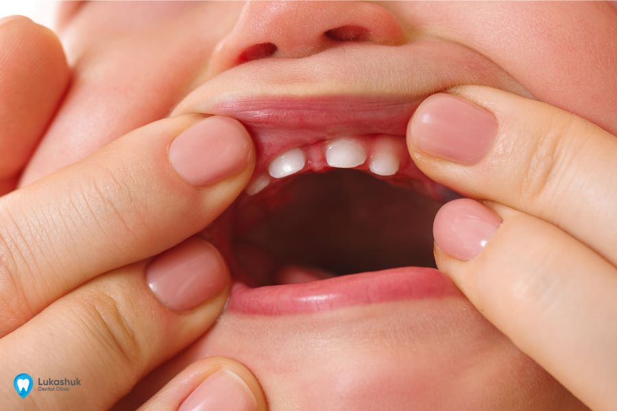 Появление верхних зубов у ребенка