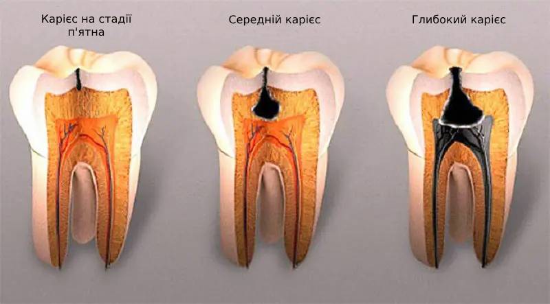 Глибина ураження зуба карієсом | Фото 3 - Клініка Лукашука